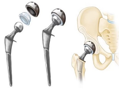 Эндопротезирование тазобедренного сустава